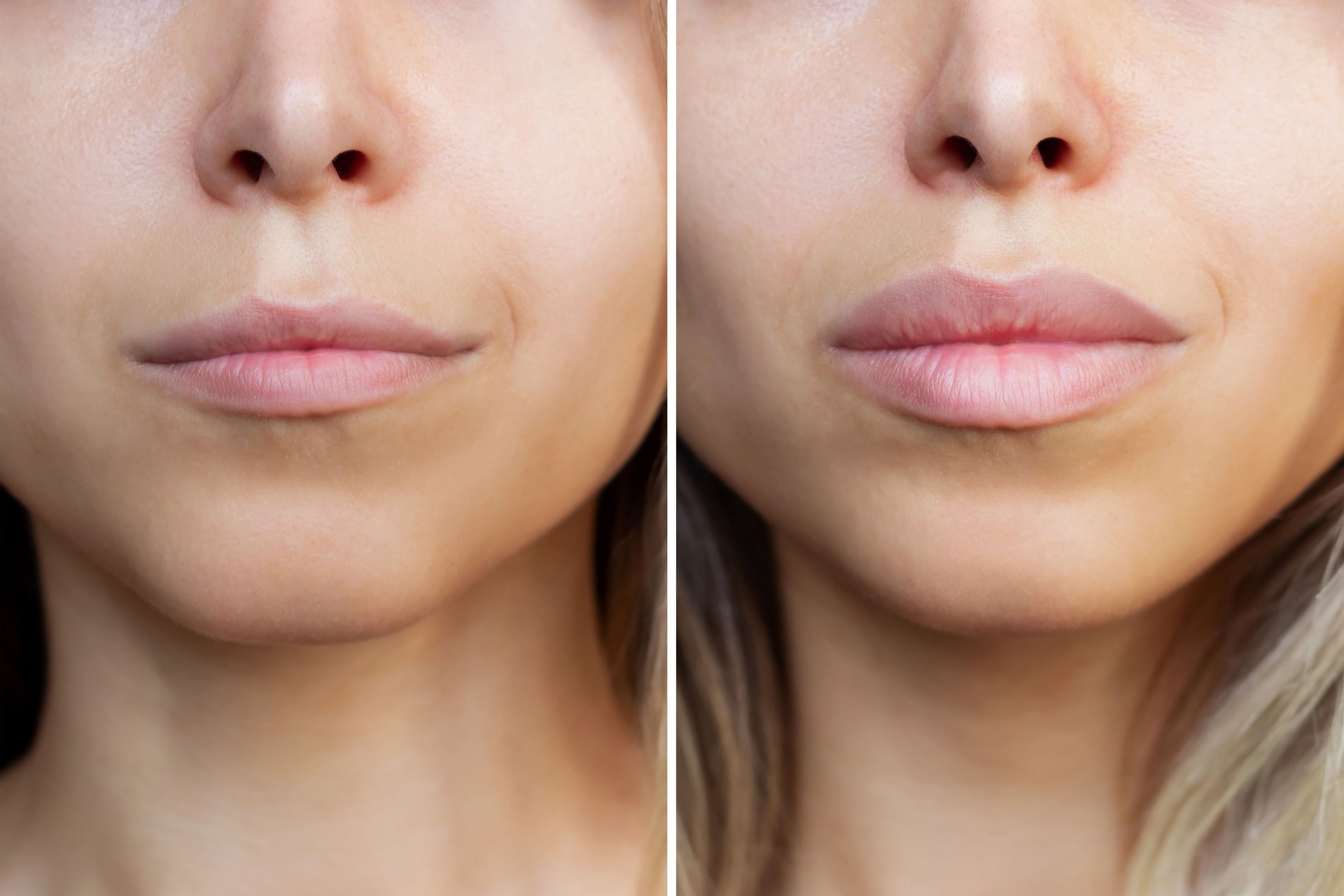 Result of lip augmentation. Woman lips before and after enhancement. Injection of fillers